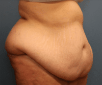 Tummy Tuck