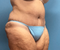 Tummy Tuck