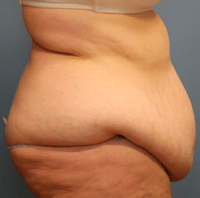 Tummy Tuck