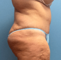 Tummy Tuck