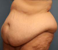 Tummy Tuck