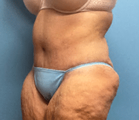 Tummy Tuck