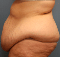 Tummy Tuck