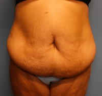 St. Louis Panniculectomy Before and After Photos - Chesterfield Plastic  Surgery Photo Gallery - Dr Scott Geiger