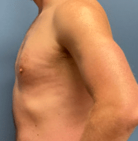 Gynecomastia Surgery