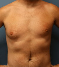 Gynecomastia Surgery