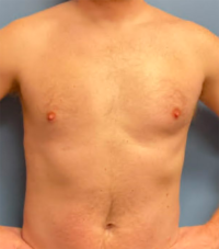 Gynecomastia Surgery