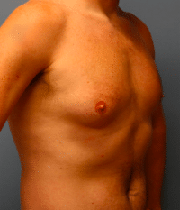 Gynecomastia Surgery