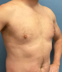 Gynecomastia Surgery