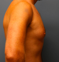 Gynecomastia Surgery