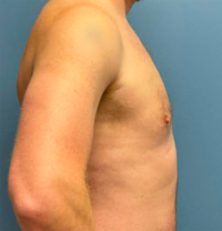 Gynecomastia Surgery