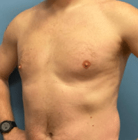 Gynecomastia Surgery