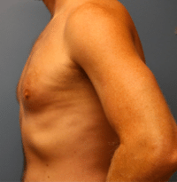 Gynecomastia Surgery