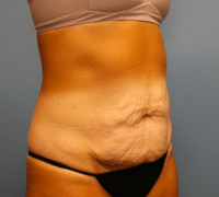 Tummy Tuck