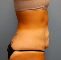 Tummy Tuck