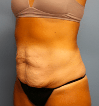 Tummy Tuck