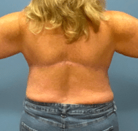 Patient 2866, Midback-Bra Line Liposuction Gallery