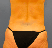 Circumferential Body Lift