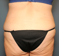 Circumferential Body Lift