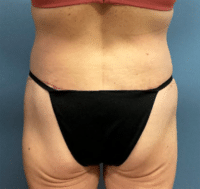 Circumferential Body Lift