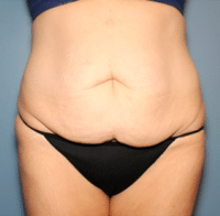 Circumferential Body Lift