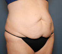 Circumferential Body Lift