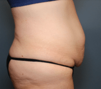 Circumferential Body Lift