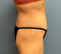 Circumferential Body Lift