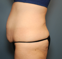 Circumferential Body Lift