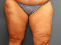 Liposuction