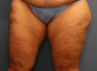 Liposuction