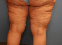 Liposuction