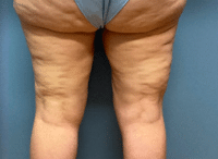 Liposuction