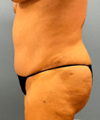 Tummy Tuck