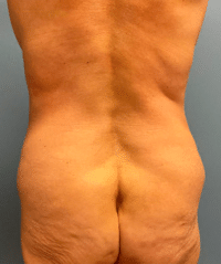 Tummy Tuck