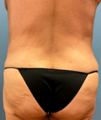 Tummy Tuck