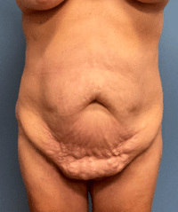 Tummy Tuck