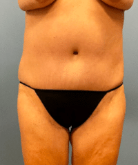 Tummy Tuck