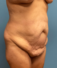 Tummy Tuck