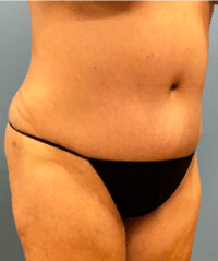 Tummy Tuck