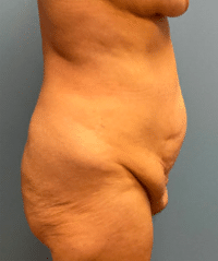 Tummy Tuck