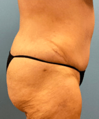 Tummy Tuck