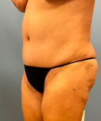 Tummy Tuck