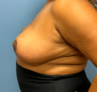 Breast Reduction