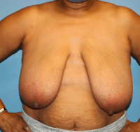 Breast Reduction