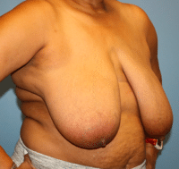 Breast Reduction