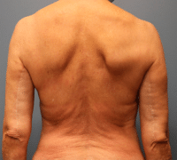 St. Louis Upper Back/Bra Line Lift Before and After Photos