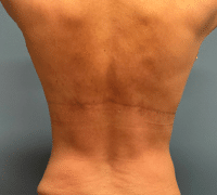 Upper Back/Bra Line Lift