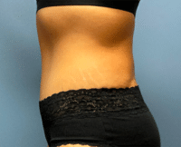 Tummy Tuck