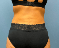 Tummy Tuck